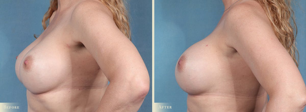 Breast Implant Revision/Replacement Before & After Gallery - Patient 972168 - Image 3