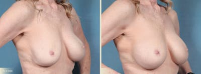 Breast Implant Revision/Replacement Before & After Gallery - Patient 250399 - Image 2