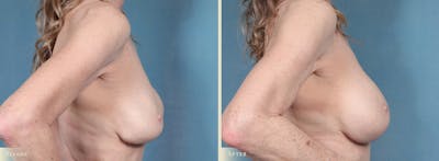 Breast Implant Revision/Replacement Before & After Gallery - Patient 250399 - Image 3