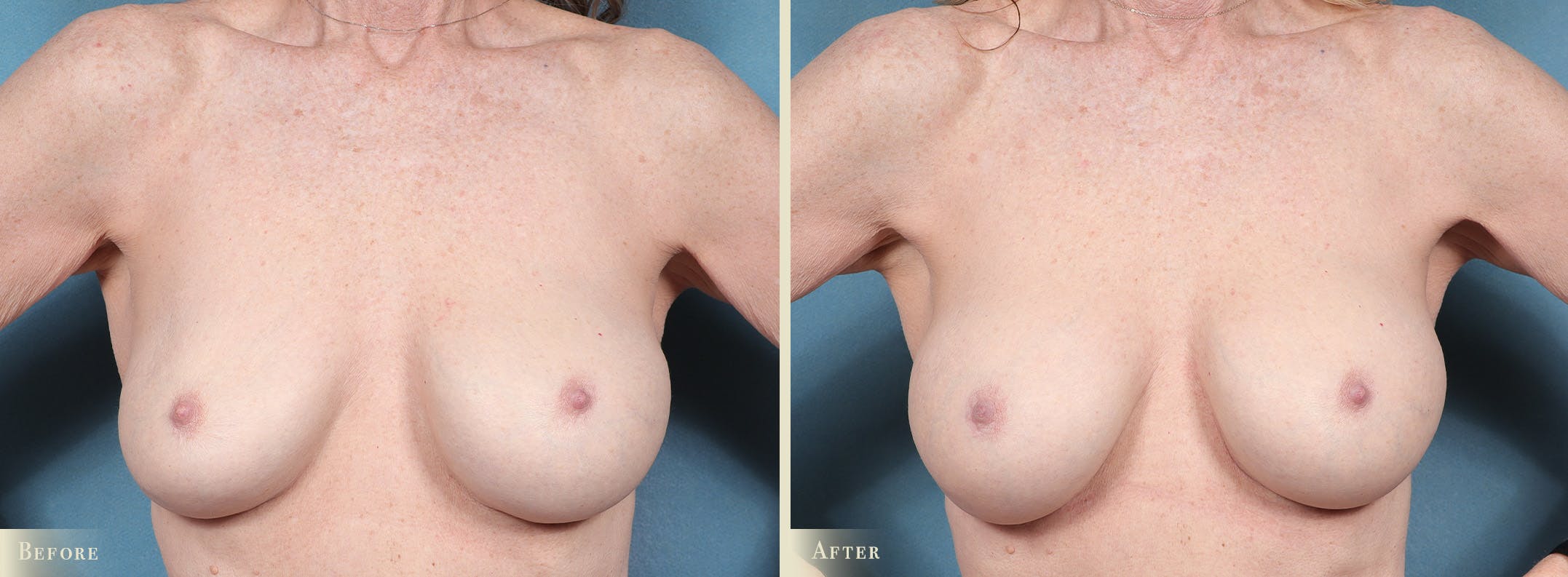 Breast Implant Revision/Replacement Before & After Gallery - Patient 250399 - Image 1
