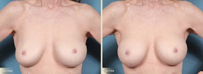 Breast Implant Revision/Replacement Before & After Gallery - Patient 250399 - Image 1
