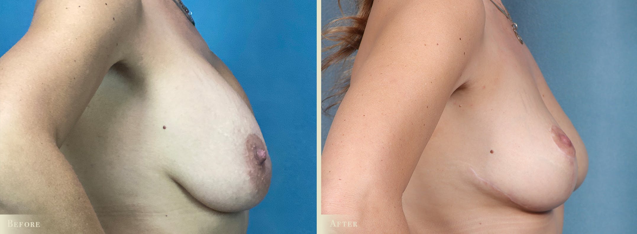 Fat Grafting to Breasts Before & After Gallery - Patient 565274 - Image 3