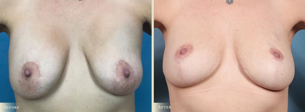 Fat Grafting to Breasts Before & After Gallery - Patient 565274 - Image 1