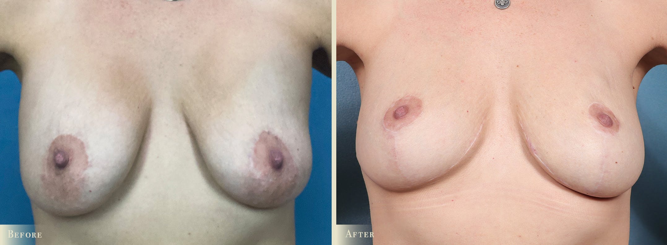 Fat Grafting to Breasts Before & After Gallery - Patient 565274 - Image 1