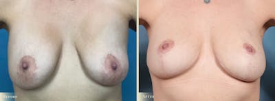 Fat Grafting to Breasts Before & After Gallery - Patient 565274 - Image 1