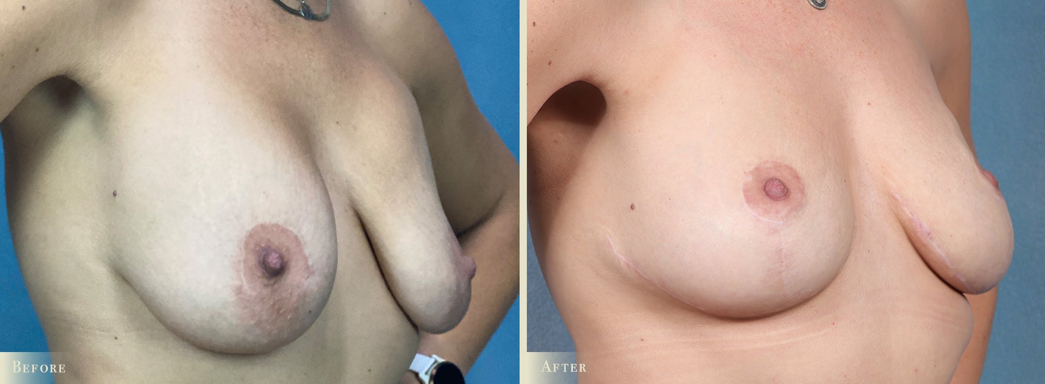 Fat Grafting to Breasts Before & After Gallery - Patient 565274 - Image 2