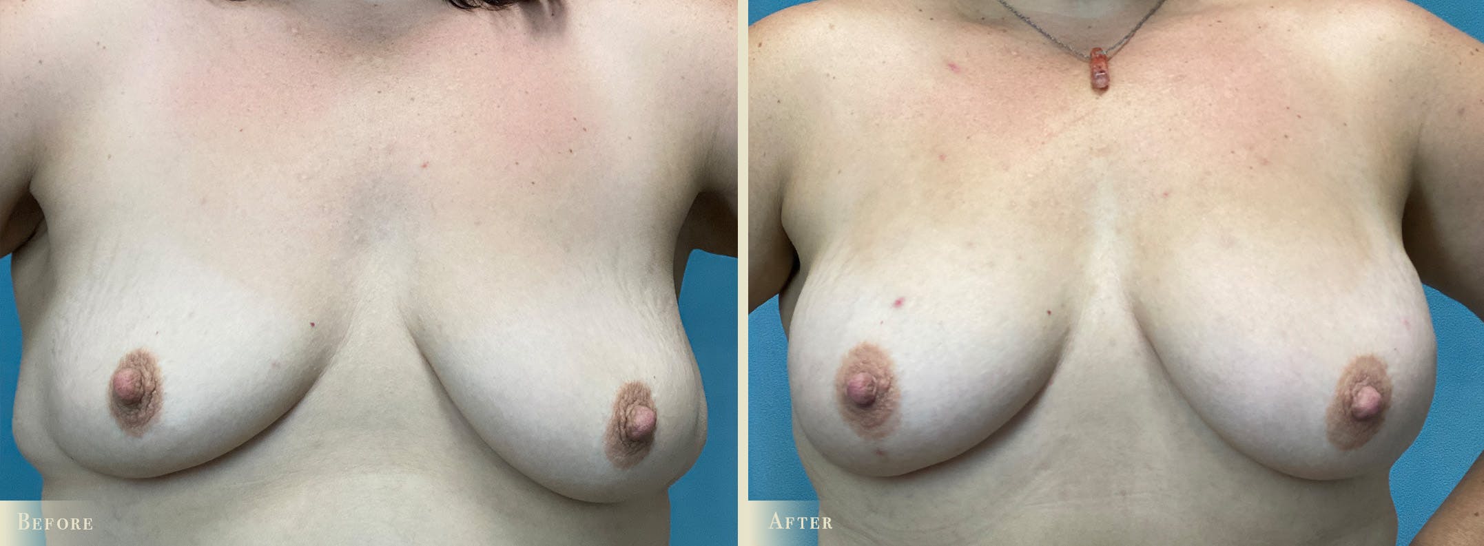 Fat Grafting to Breasts Before & After Gallery - Patient 207231 - Image 1