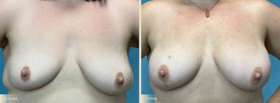 Fat Grafting to Breasts Before & After Gallery - Patient 207231 - Image 1
