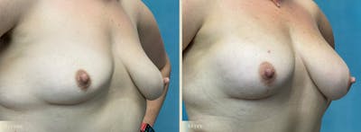 Fat Grafting to Breasts Before & After Gallery - Patient 207231 - Image 2