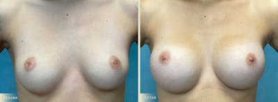 Breast Augmentation Before & After Gallery - Patient 221080 - Image 1