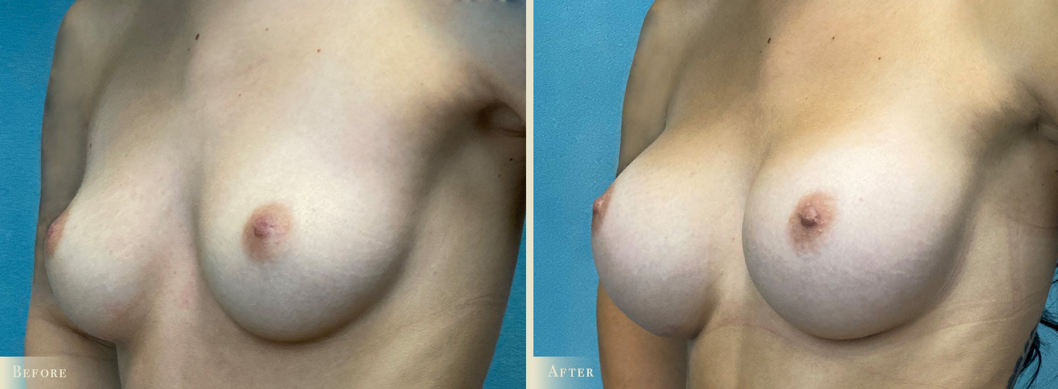 Breast Augmentation Before & After Gallery - Patient 221080 - Image 2
