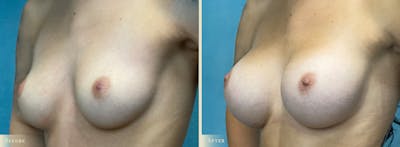 Breast Augmentation Before & After Gallery - Patient 221080 - Image 2