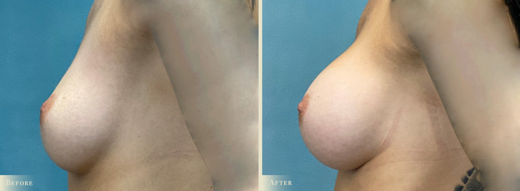 Breast Augmentation Before & After Gallery - Patient 221080 - Image 3