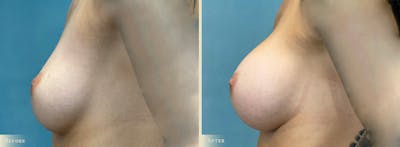 Breast Augmentation Before & After Gallery - Patient 221080 - Image 3