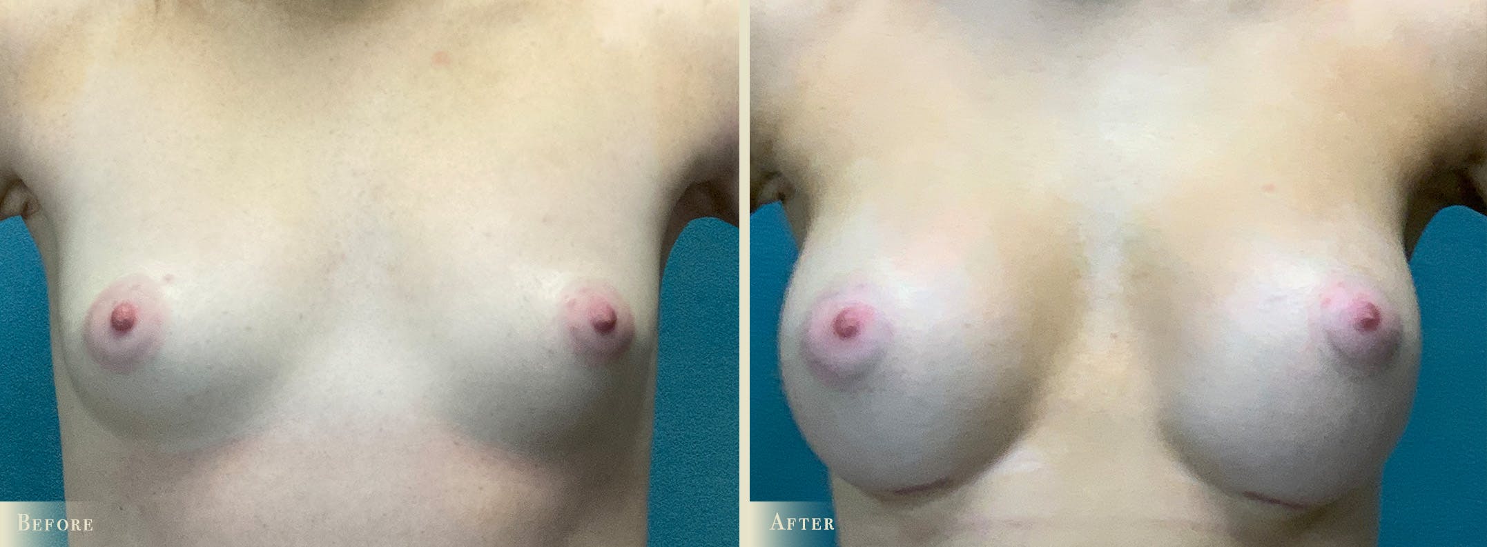 Breast Augmentation Before & After Gallery - Patient 408266 - Image 1