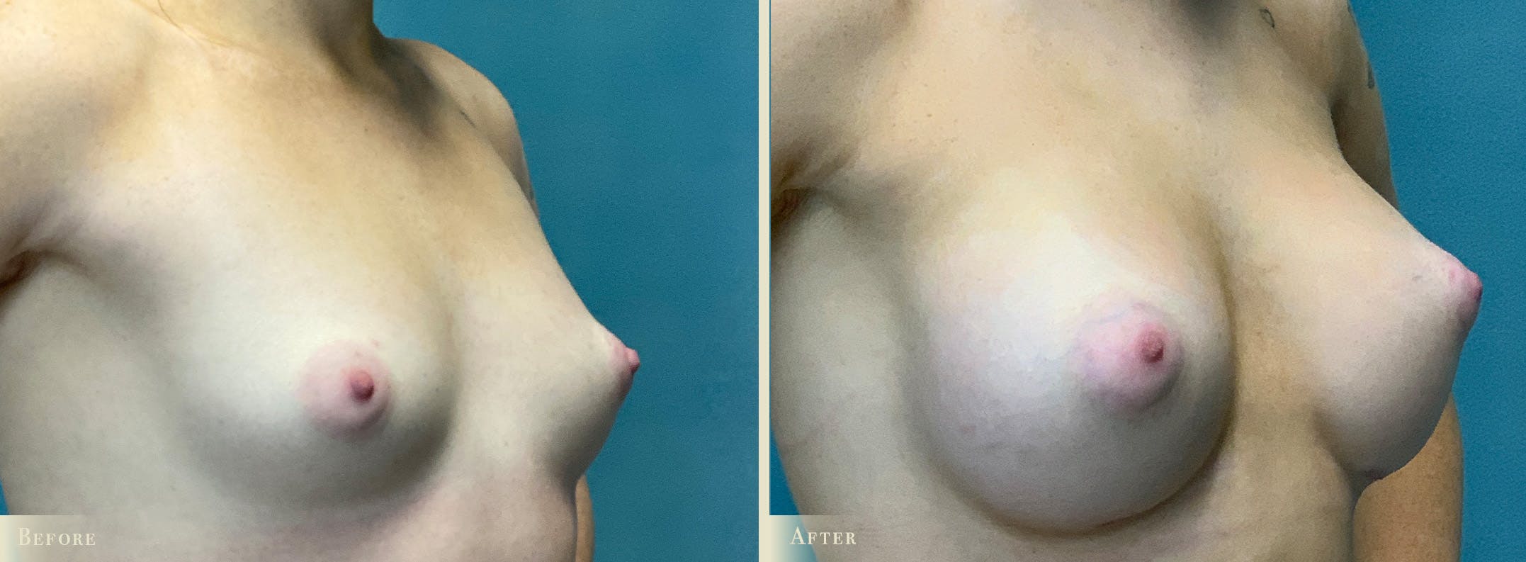 Breast Augmentation Before & After Gallery - Patient 408266 - Image 2