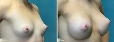 Breast Augmentation Before & After Gallery - Patient 408266 - Image 2