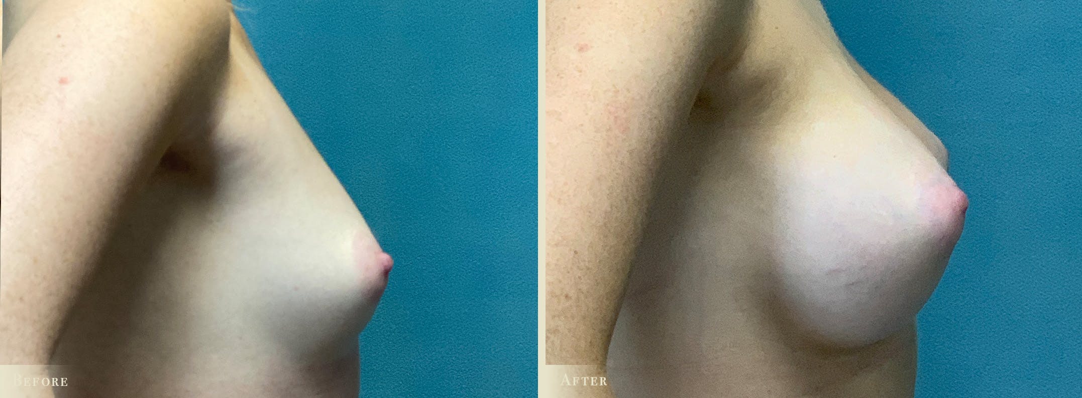 Breast Augmentation Before & After Gallery - Patient 408266 - Image 3