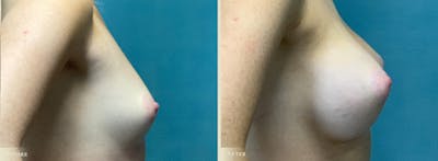 Breast Augmentation Before & After Gallery - Patient 408266 - Image 3