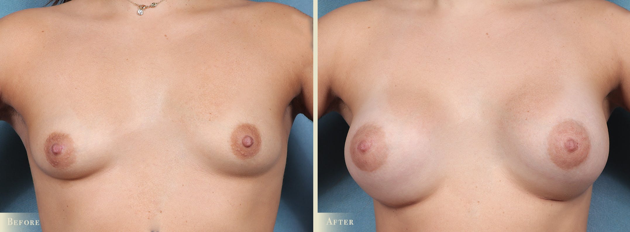 Breast Augmentation Before & After Gallery - Patient 272055 - Image 1
