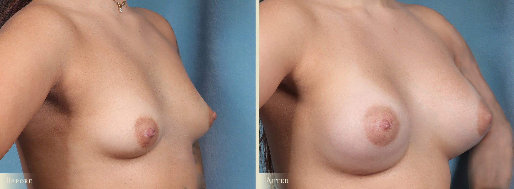 Breast Augmentation Before & After Gallery - Patient 272055 - Image 2