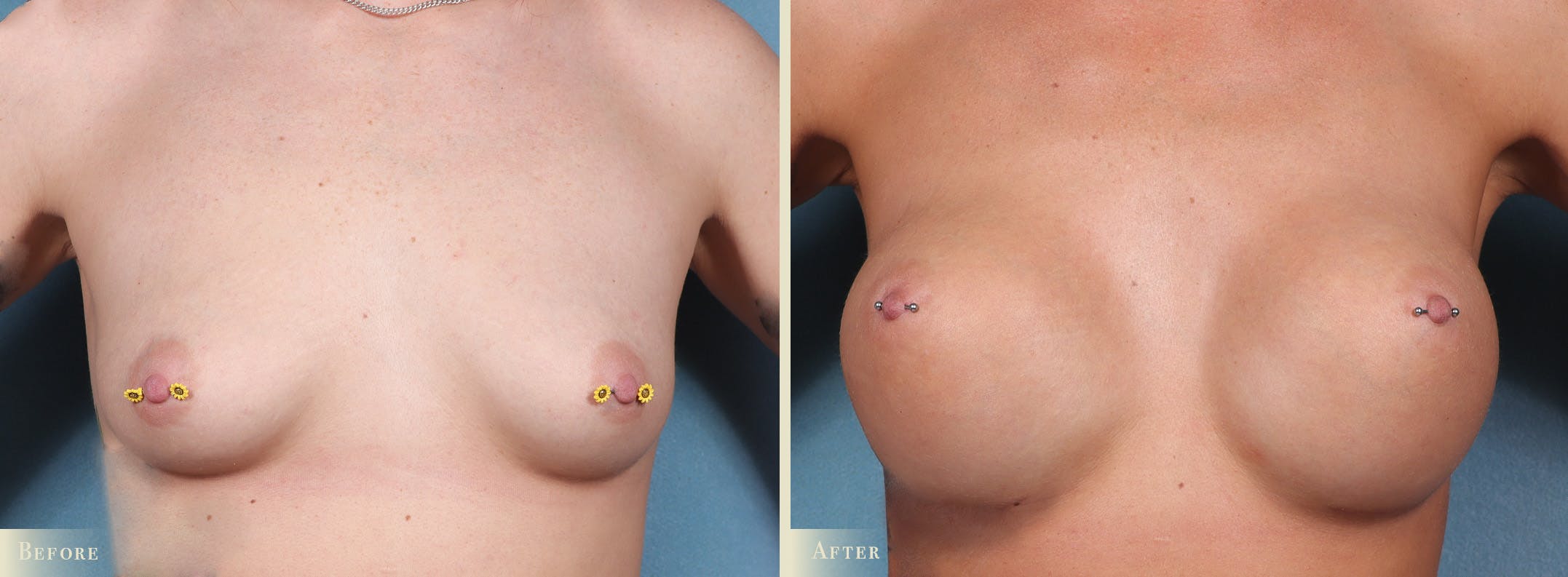 Breast Augmentation Before & After Gallery - Patient 873582 - Image 1