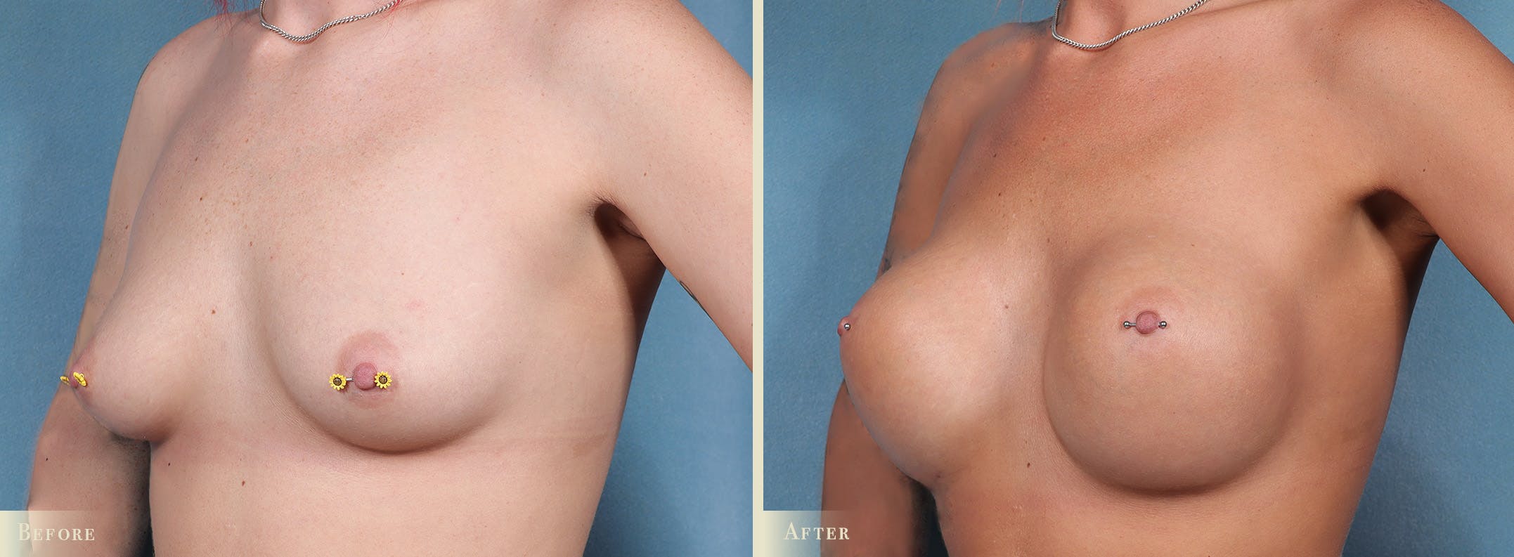 Breast Augmentation Before & After Gallery - Patient 873582 - Image 2