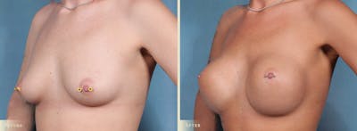 Breast Augmentation Before & After Gallery - Patient 873582 - Image 2