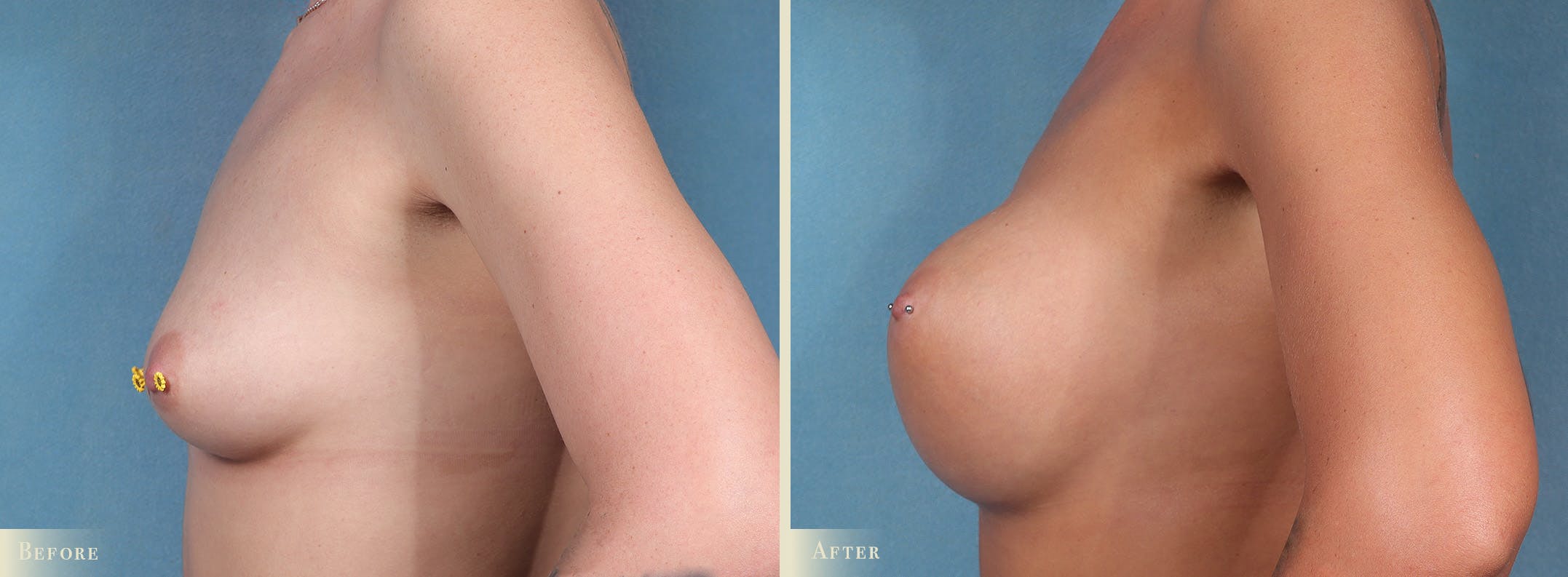 Breast Augmentation Before & After Gallery - Patient 873582 - Image 3