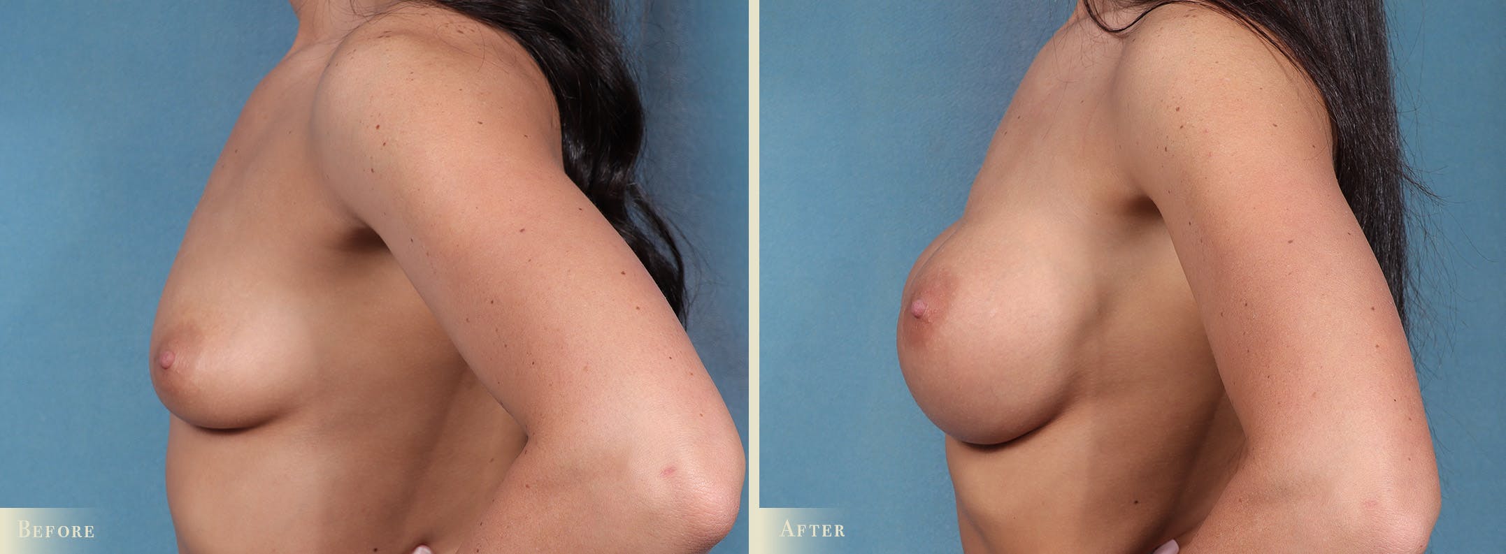 Breast Augmentation Before & After Gallery - Patient 312329 - Image 3