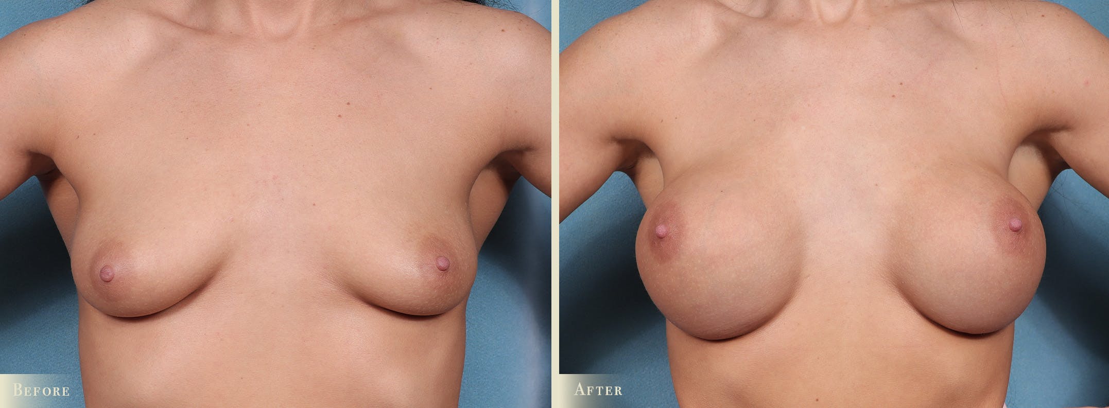 Breast Augmentation Before & After Gallery - Patient 312329 - Image 1
