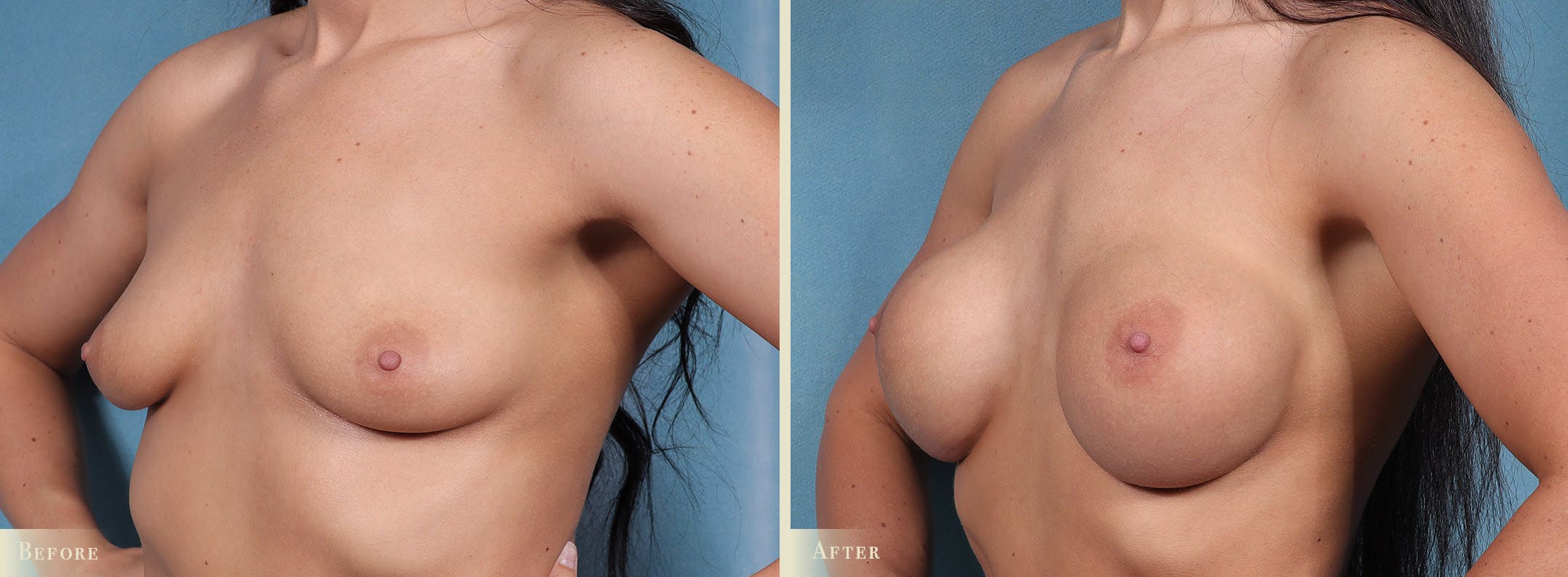 Breast Augmentation Before & After Gallery - Patient 312329 - Image 2