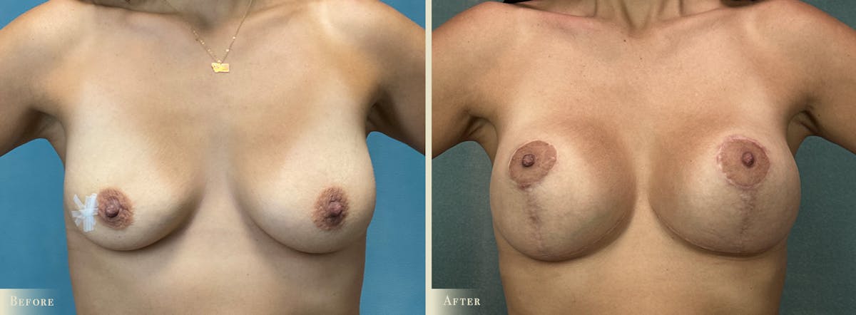 Breast Augmentation and Lift  Before & After Gallery - Patient 216648 - Image 1
