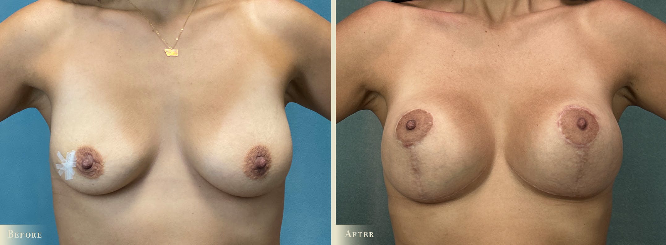 Breast Augmentation and Lift Before & After Gallery - Patient 216648 - Image 1