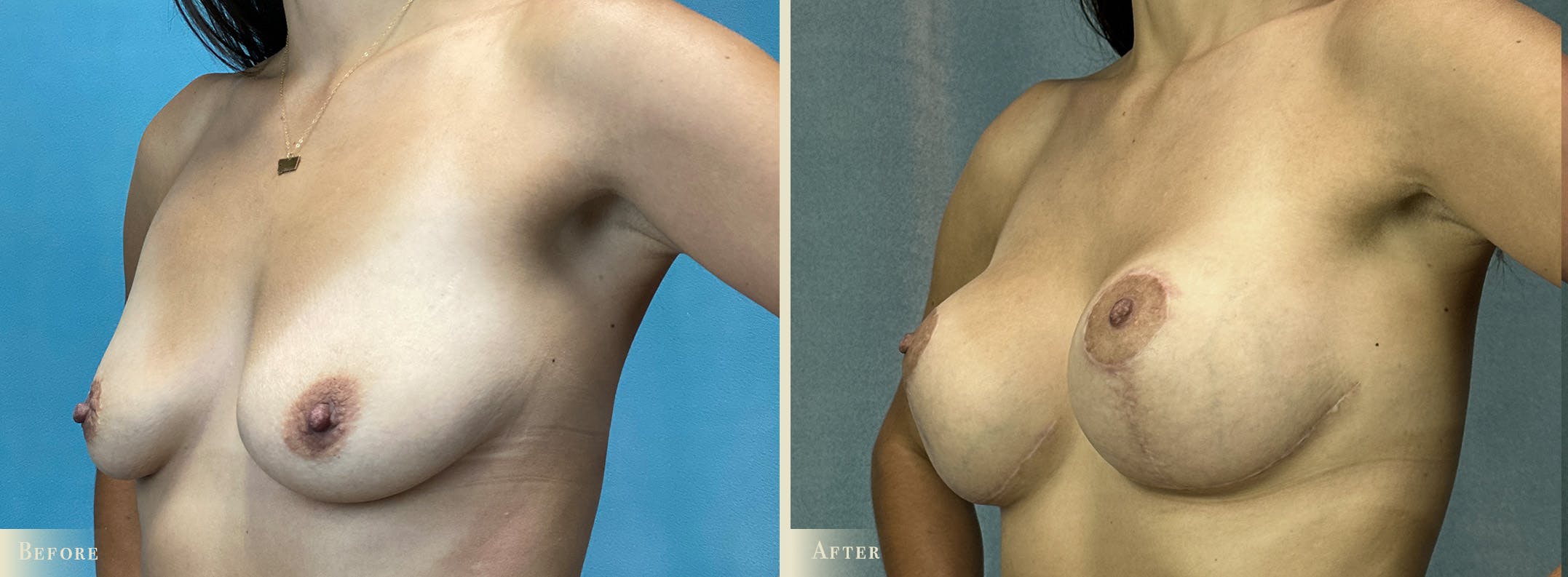 Breast Augmentation and Lift Before & After Gallery - Patient 216648 - Image 2