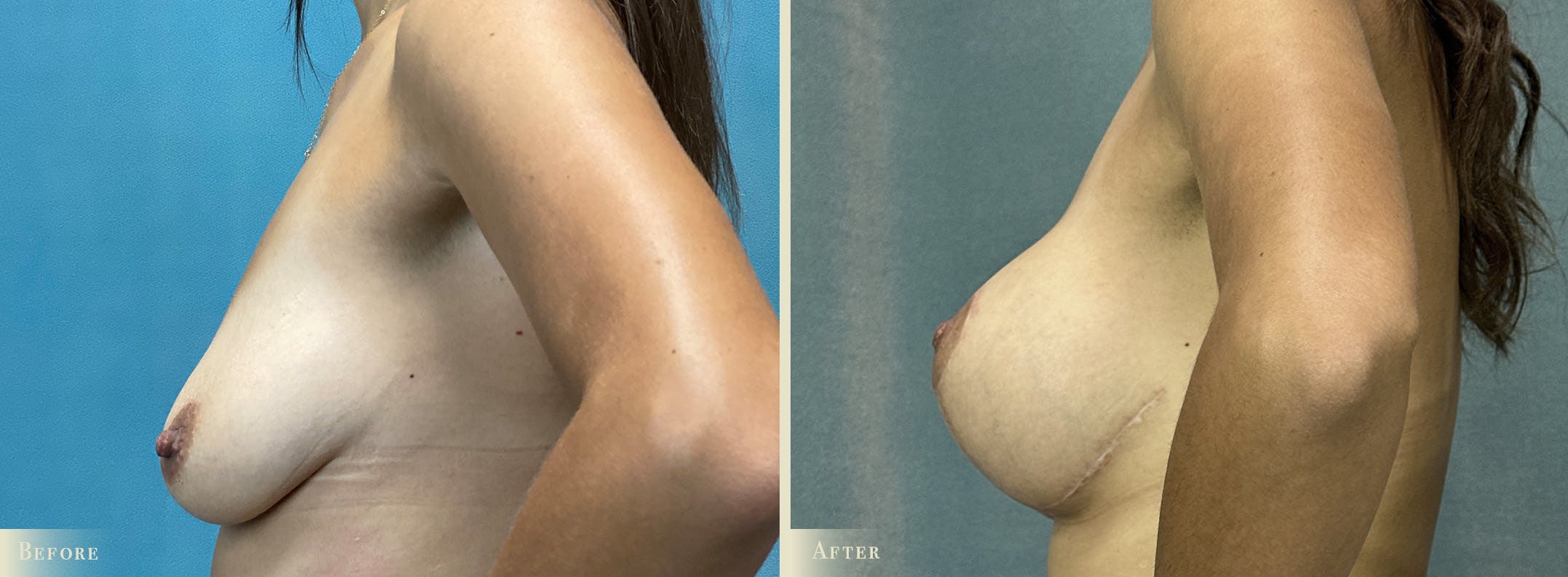 Breast Augmentation and Lift Before & After Gallery - Patient 216648 - Image 3