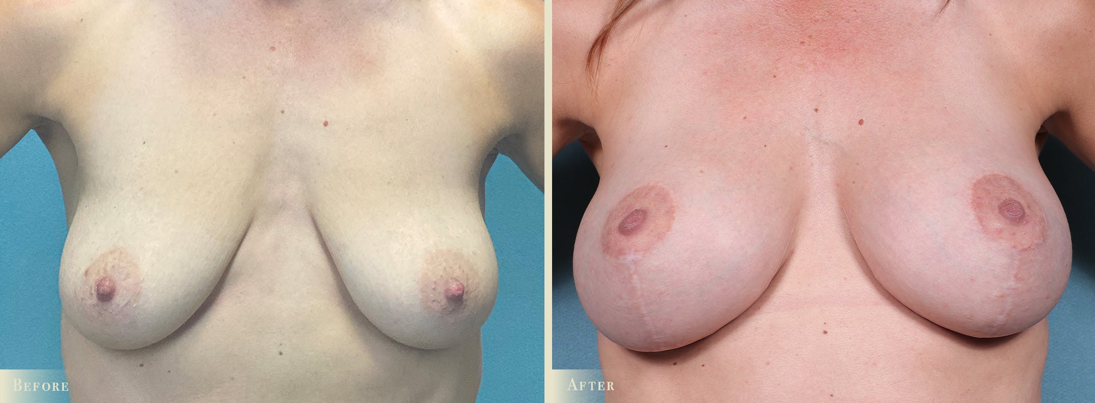 Breast Augmentation and Lift Before & After Gallery - Patient 360785 - Image 1