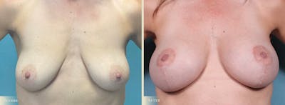 Breast Augmentation and Lift  Before & After Gallery - Patient 360785 - Image 1
