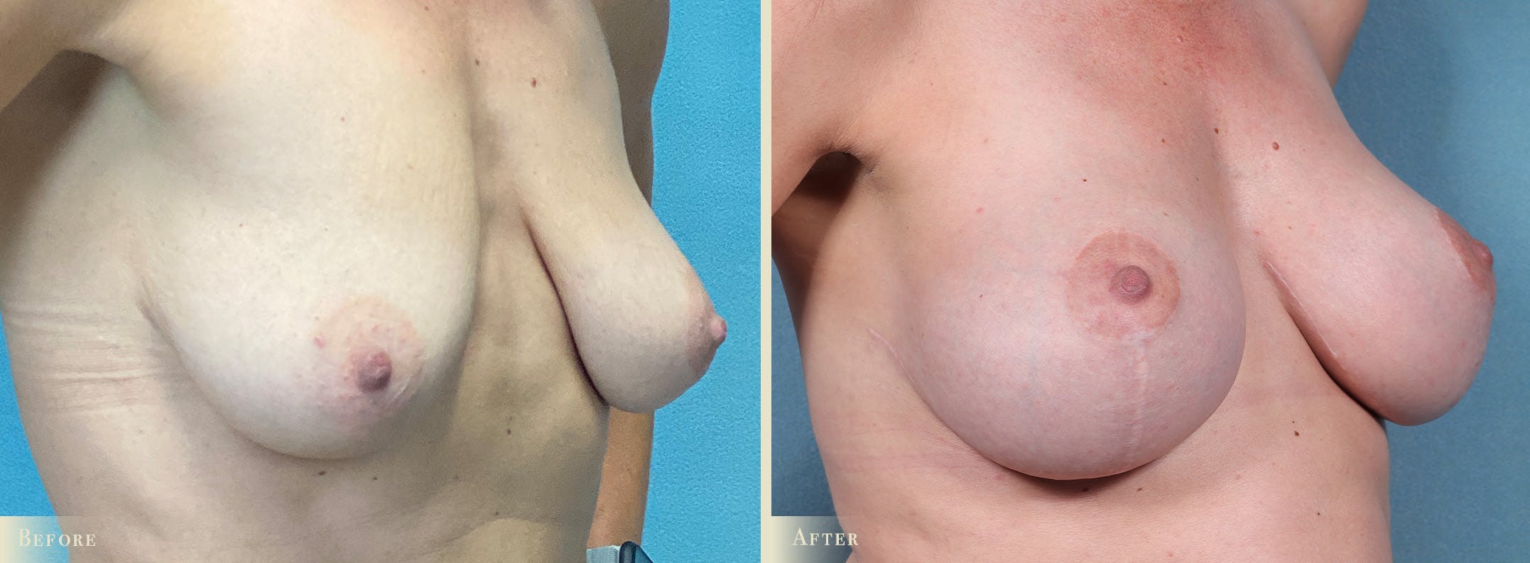 Breast Augmentation and Lift Before & After Gallery - Patient 360785 - Image 2