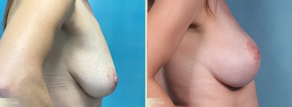 Breast Augmentation and Lift  Before & After Gallery - Patient 360785 - Image 3