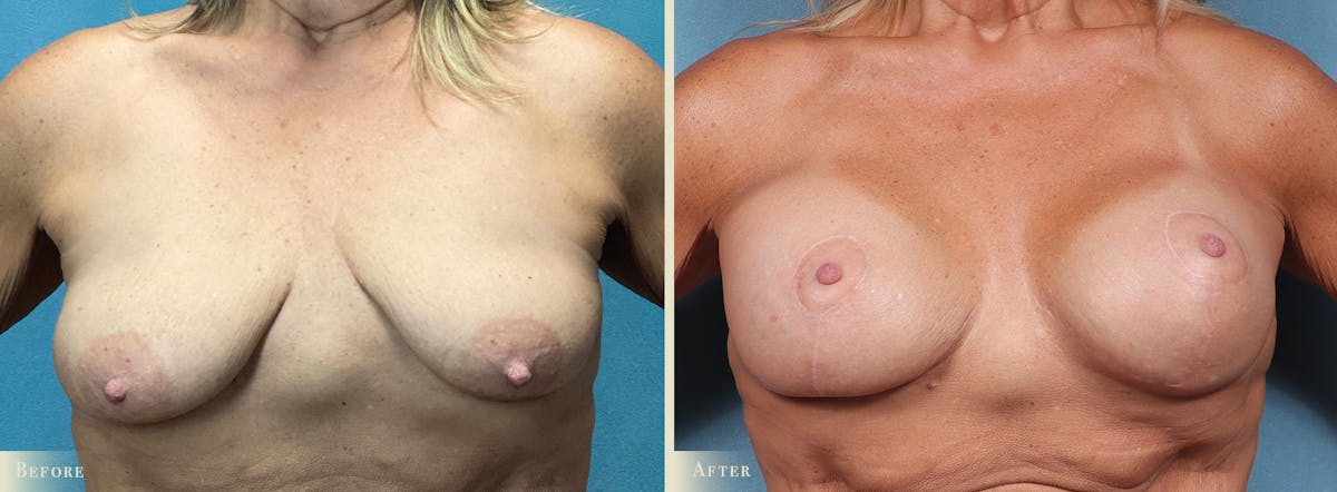 Breast Augmentation and Lift  Before & After Gallery - Patient 338835 - Image 1