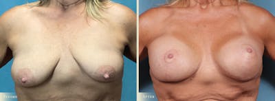 Breast Augmentation and Lift  Before & After Gallery - Patient 338835 - Image 1