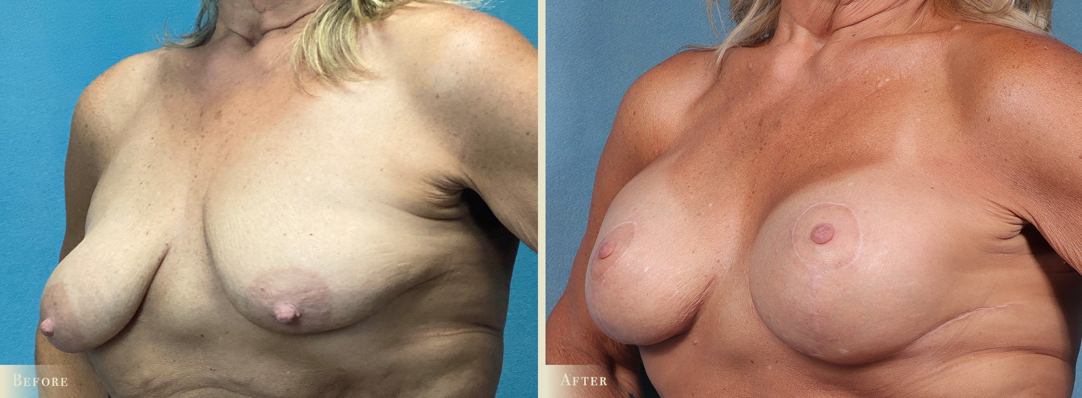 Breast Augmentation and Lift Before & After Gallery - Patient 338835 - Image 2