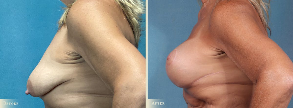 Breast Augmentation and Lift  Before & After Gallery - Patient 338835 - Image 3