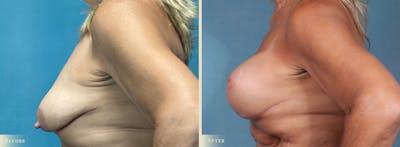 Breast Augmentation and Lift Before & After Gallery - Patient 338835 - Image 3