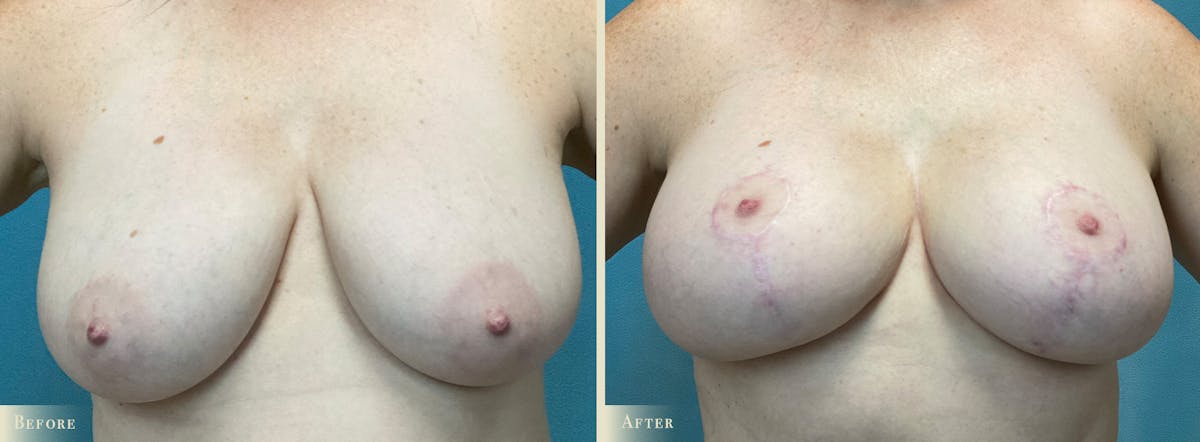 Breast Augmentation and Lift  Before & After Gallery - Patient 363133 - Image 1