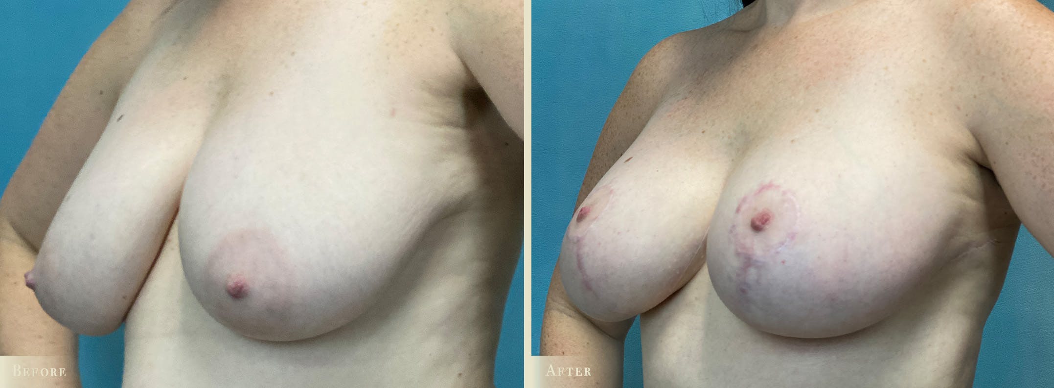 Breast Augmentation and Lift Before & After Gallery - Patient 363133 - Image 2