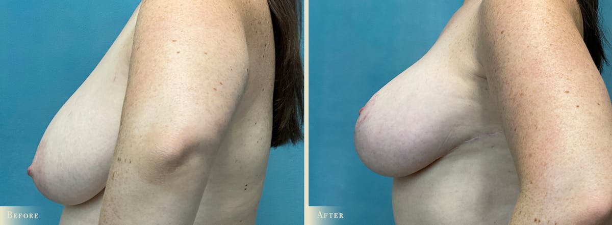 Breast Augmentation and Lift  Before & After Gallery - Patient 363133 - Image 3
