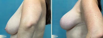 Breast Augmentation and Lift Before & After Gallery - Patient 363133 - Image 3