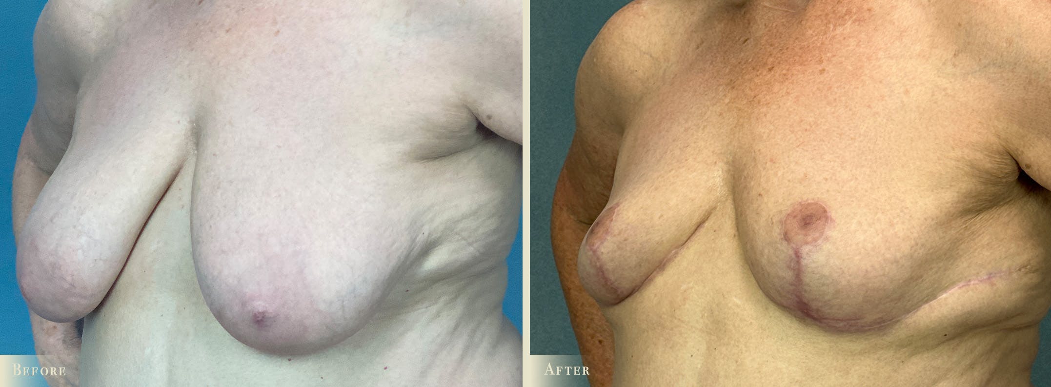 Breast Reduction Before & After Gallery - Patient 471901 - Image 2